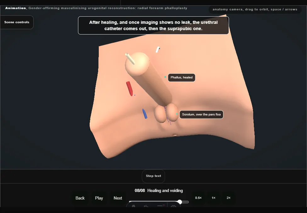Gender-affirming masculinising urogenital reconstruction: radial forearm phalloplasty. Step 8: Healing and voiding. Captured frame from the interactive animation.