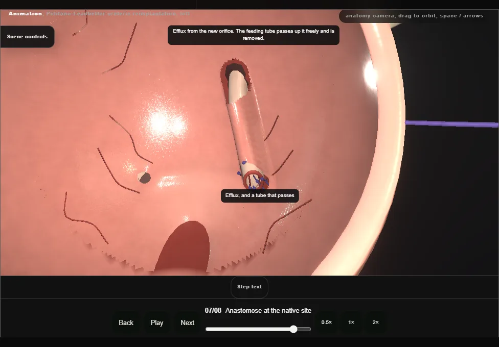 Politano-Leadbetter ureteric reimplantation, left. Step 7: Anastomose at the native site. Captured frame from the interactive animation.