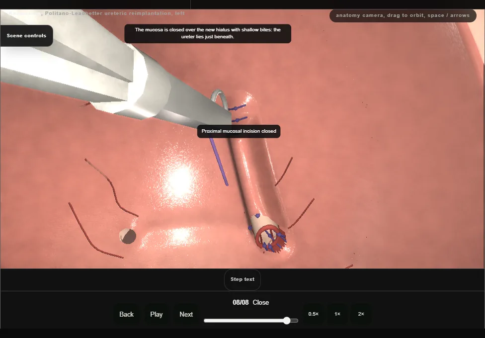 Politano-Leadbetter ureteric reimplantation, left. Step 8: Close. Captured frame from the interactive animation.