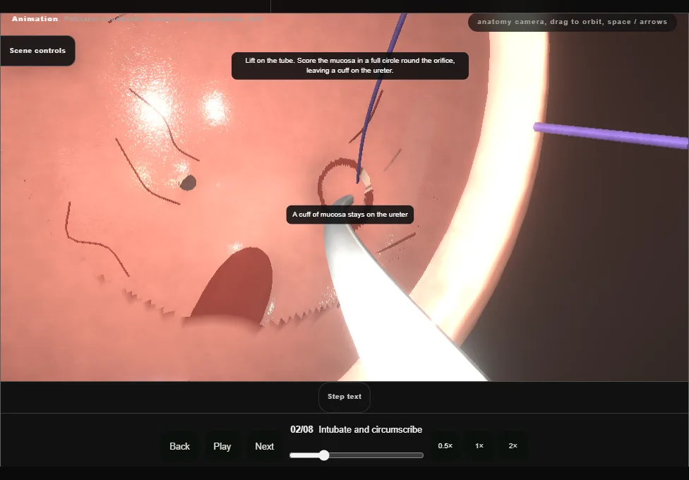 Politano-Leadbetter ureteric reimplantation, left. Step 2: Intubate and circumscribe. Captured frame from the interactive animation.