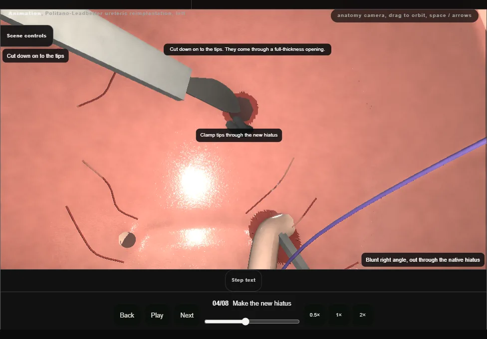 Politano-Leadbetter ureteric reimplantation, left. Step 4: Make the new hiatus. Captured frame from the interactive animation.