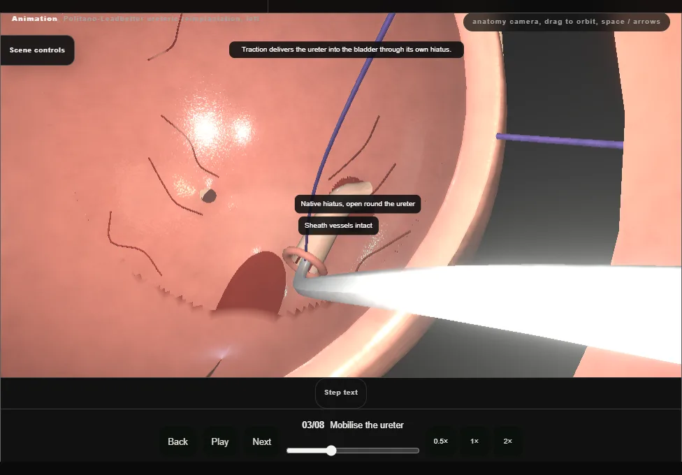 Politano-Leadbetter ureteric reimplantation, left. Step 3: Mobilise the ureter. Captured frame from the interactive animation.