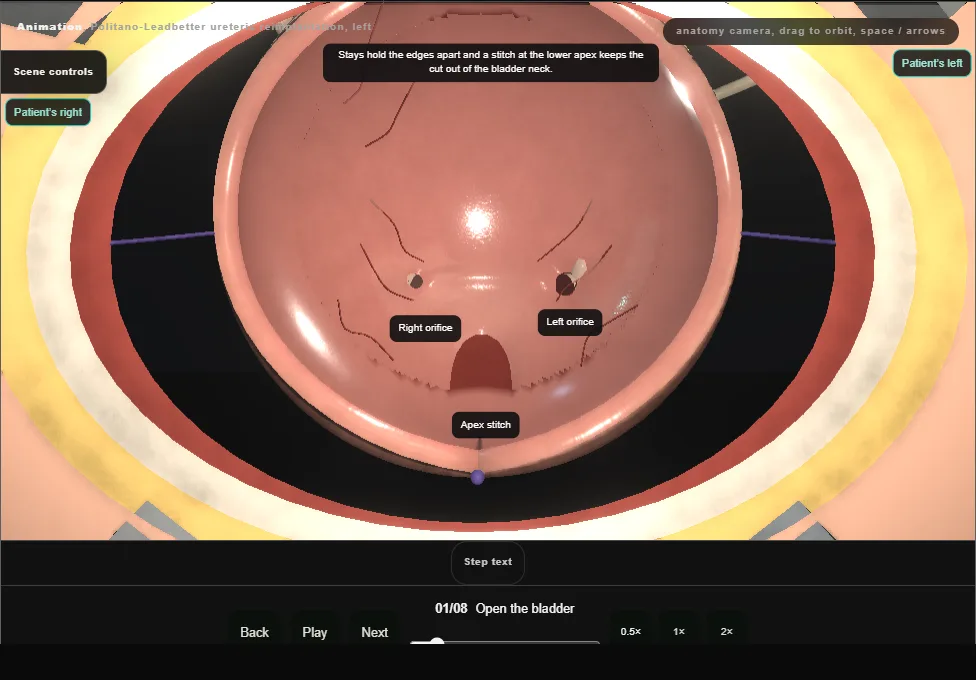 Politano-Leadbetter ureteric reimplantation, left. Step 1: Open the bladder. Captured frame from the interactive animation.