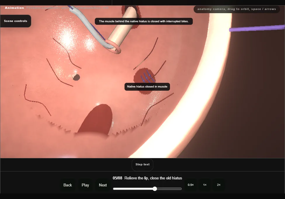Politano-Leadbetter ureteric reimplantation, left. Step 5: Relieve the lip, close the old hiatus. Captured frame from the interactive animation.