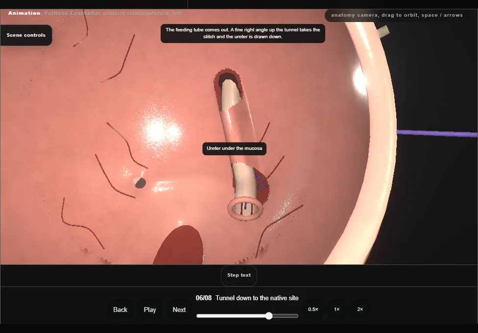 Politano-Leadbetter ureteric reimplantation, left. Step 6: Tunnel down to the native site. Captured frame from the interactive animation.