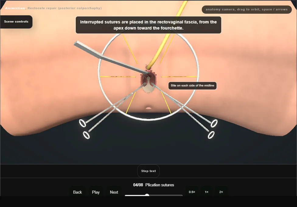 Rectocele repair (posterior colporrhaphy). Step 4: Plication sutures. Captured frame from the interactive animation.