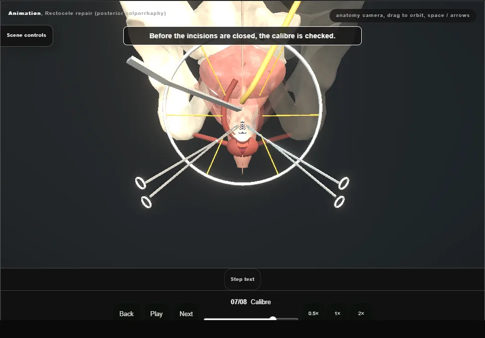 Rectocele repair (posterior colporrhaphy). Step 7: Calibre. Captured frame from the interactive animation.
