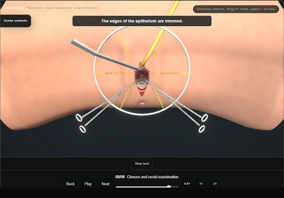 Rectocele repair (posterior colporrhaphy). Step 8: Closure and rectal examination. Captured frame from the interactive animation.