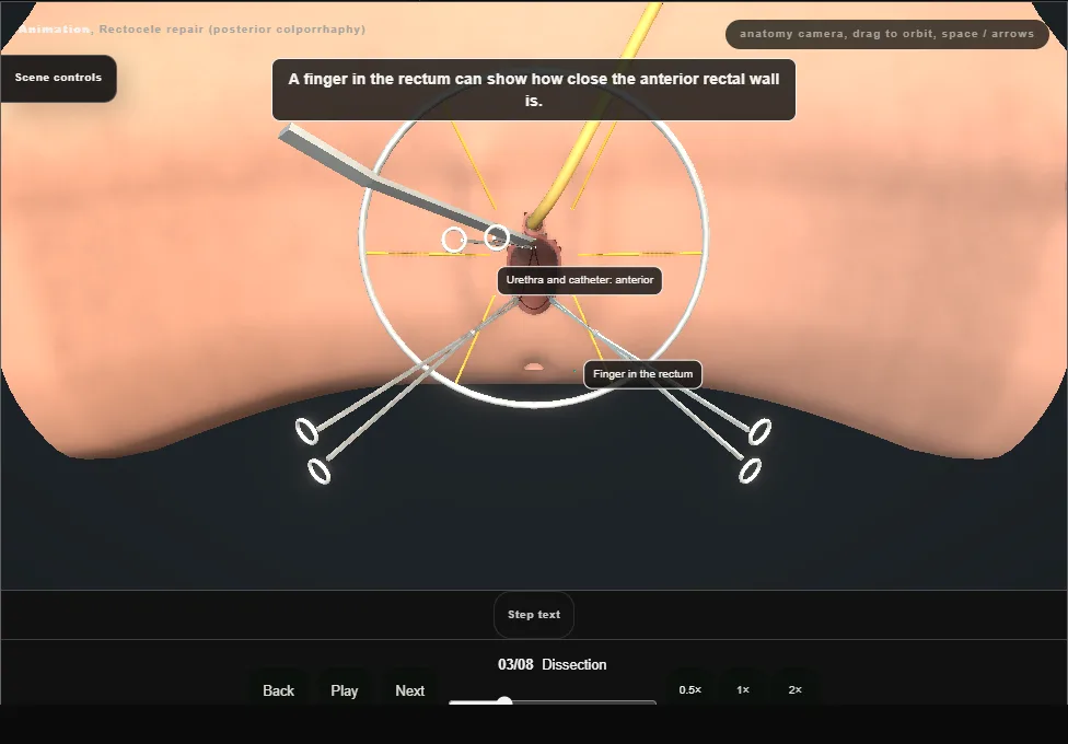 Rectocele repair (posterior colporrhaphy). Step 3: Dissection. Captured frame from the interactive animation.