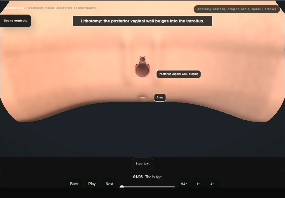 Rectocele repair (posterior colporrhaphy). Step 1: The bulge. Captured frame from the interactive animation.