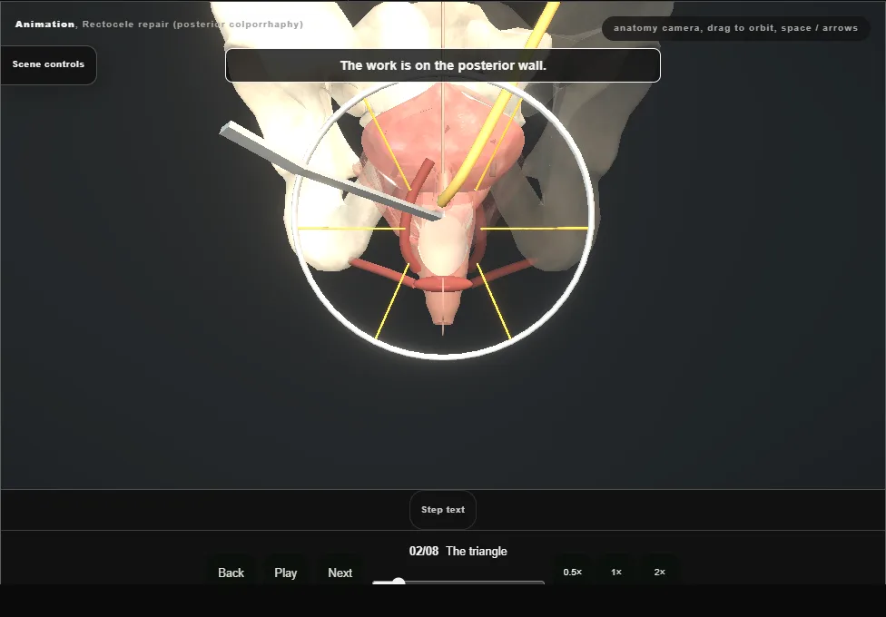 Rectocele repair (posterior colporrhaphy). Step 2: The triangle. Captured frame from the interactive animation.