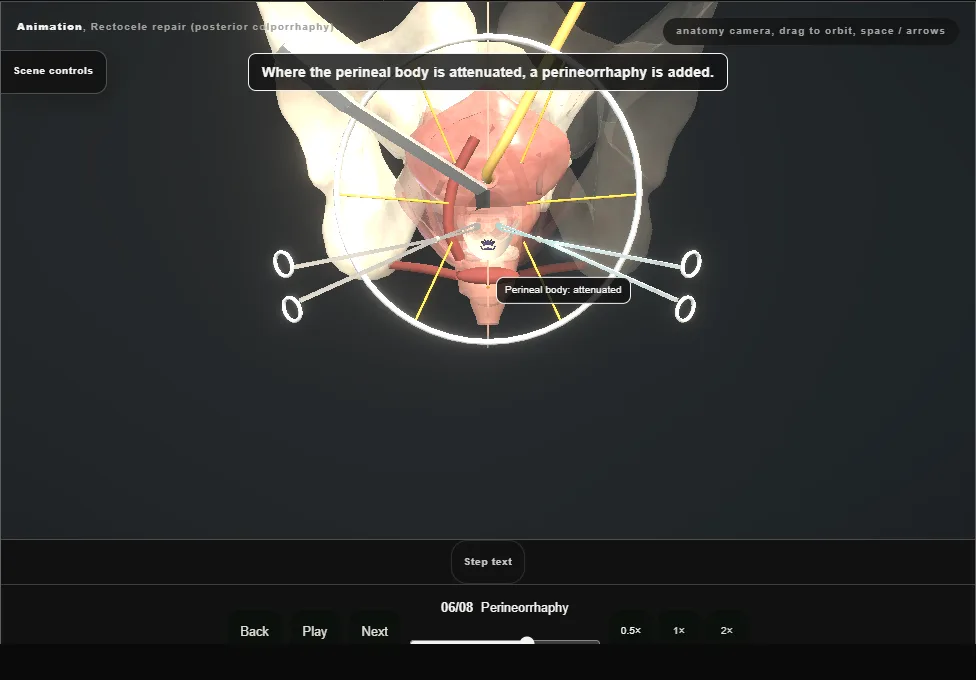 Rectocele repair (posterior colporrhaphy). Step 6: Perineorrhaphy. Captured frame from the interactive animation.