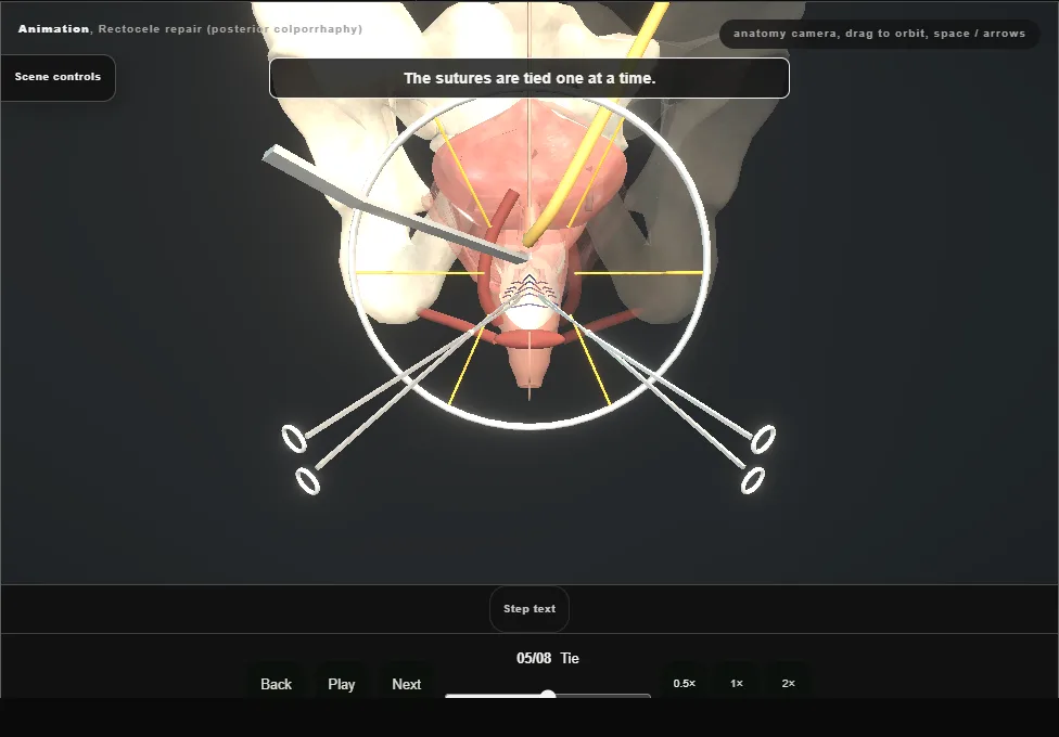 Rectocele repair (posterior colporrhaphy). Step 5: Tie. Captured frame from the interactive animation.