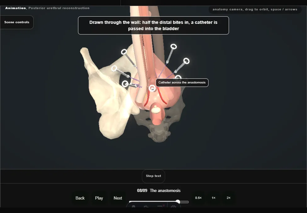 Posterior urethral reconstruction. Step 8: The anastomosis. Captured frame from the interactive animation.
