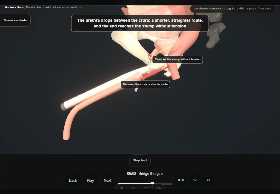 Posterior urethral reconstruction. Step 6: Bridge the gap. Captured frame from the interactive animation.