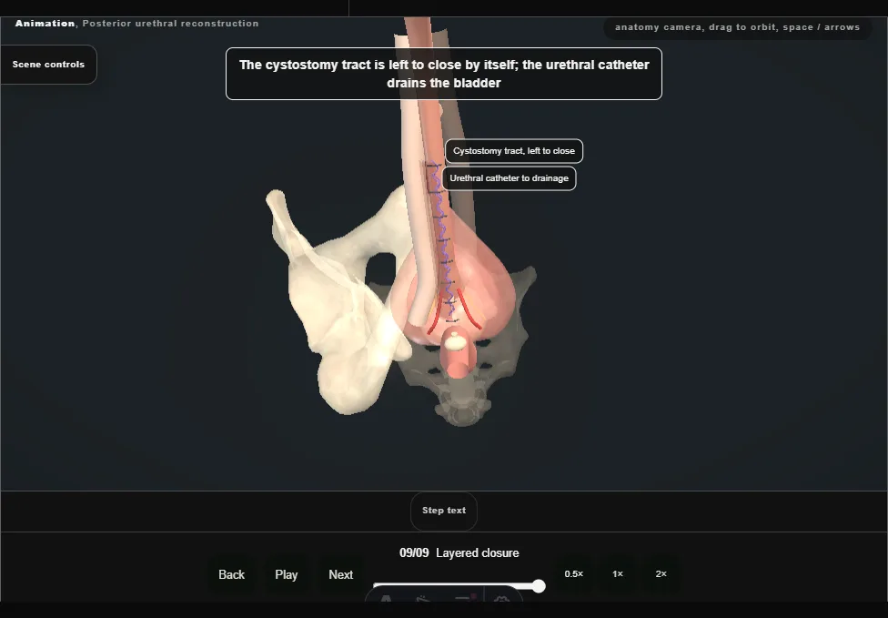 Posterior urethral reconstruction. Step 9: Layered closure. Captured frame from the interactive animation.