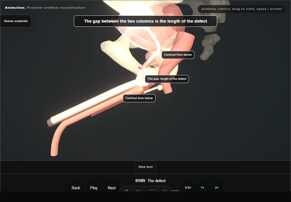 Posterior urethral reconstruction. Step 1: The defect. Captured frame from the interactive animation.