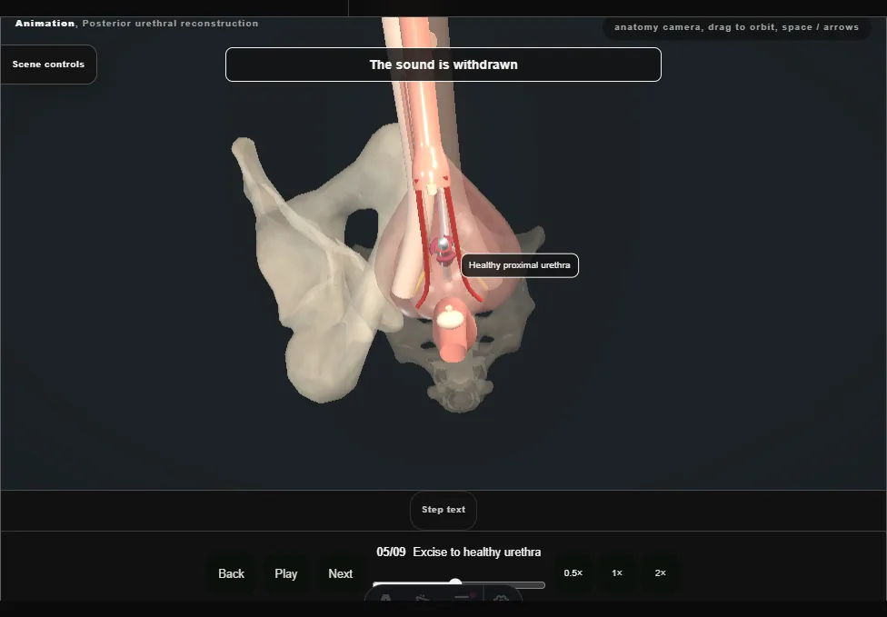 Posterior urethral reconstruction. Step 5: Excise to healthy urethra. Captured frame from the interactive animation.