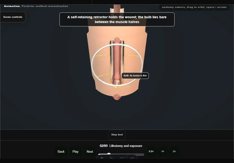 Posterior urethral reconstruction. Step 2: Lithotomy and exposure. Captured frame from the interactive animation.