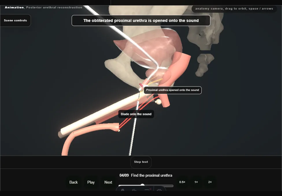 Posterior urethral reconstruction. Step 4: Find the proximal urethra. Captured frame from the interactive animation.