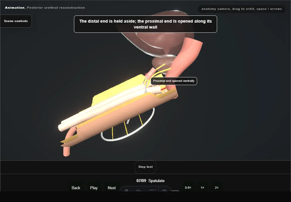 Posterior urethral reconstruction. Step 7: Spatulate. Captured frame from the interactive animation.