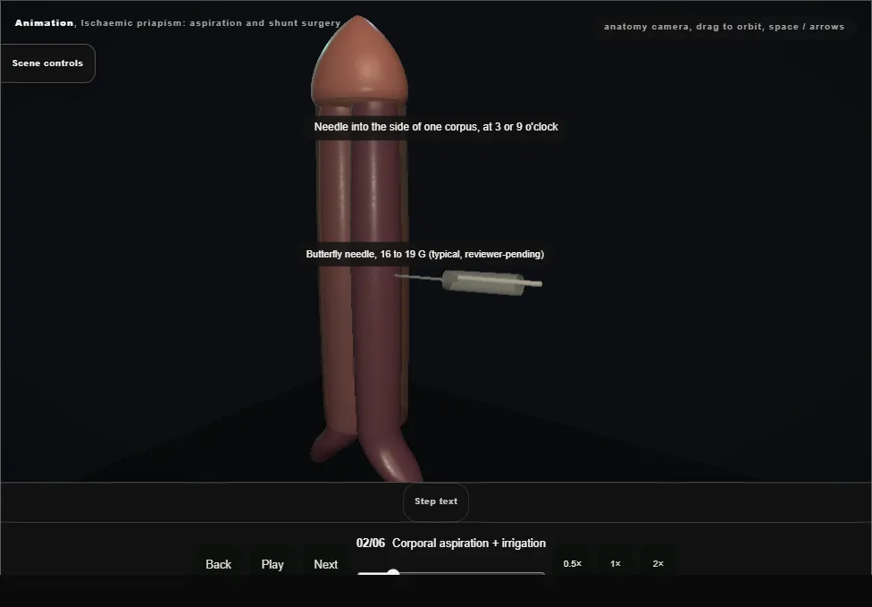 Ischaemic priapism: aspiration and shunt surgery. Step 2: Corporal aspiration + irrigation. Captured frame from the interactive animation.