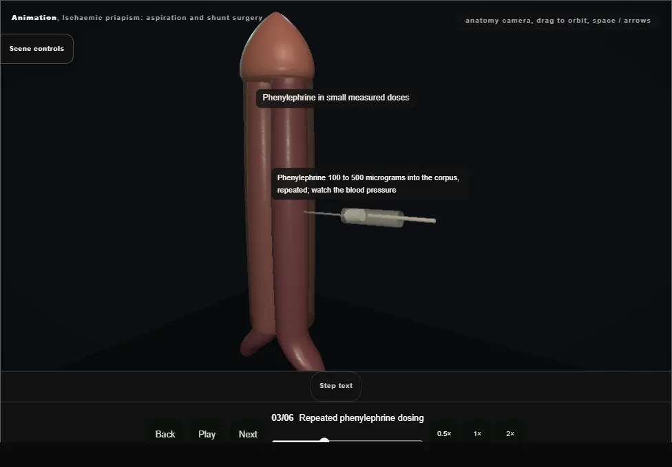 Ischaemic priapism: aspiration and shunt surgery. Step 3: Repeated phenylephrine dosing. Captured frame from the interactive animation.
