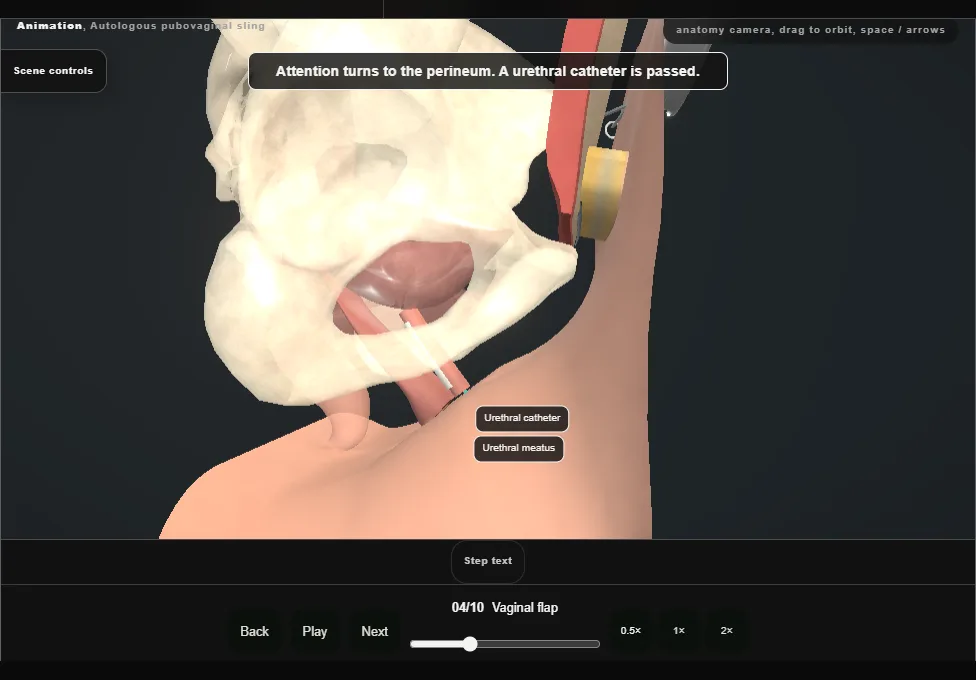 Autologous pubovaginal sling. Step 4: Vaginal flap. Captured frame from the interactive animation.