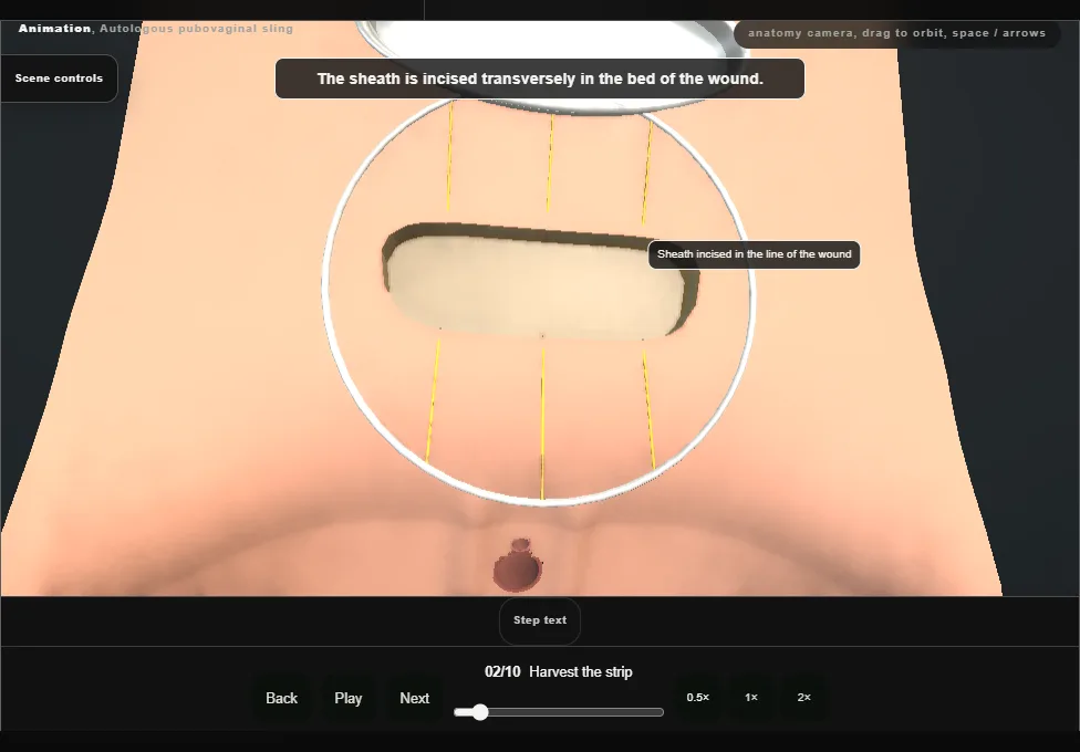 Autologous pubovaginal sling. Step 2: Harvest the strip. Captured frame from the interactive animation.