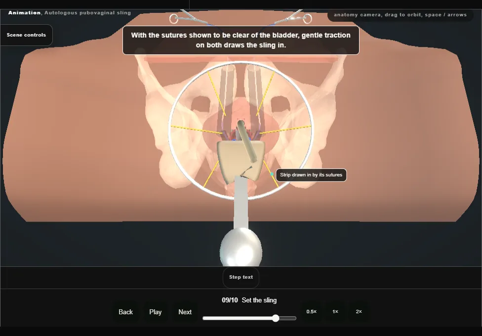 Autologous pubovaginal sling. Step 9: Set the sling. Captured frame from the interactive animation.