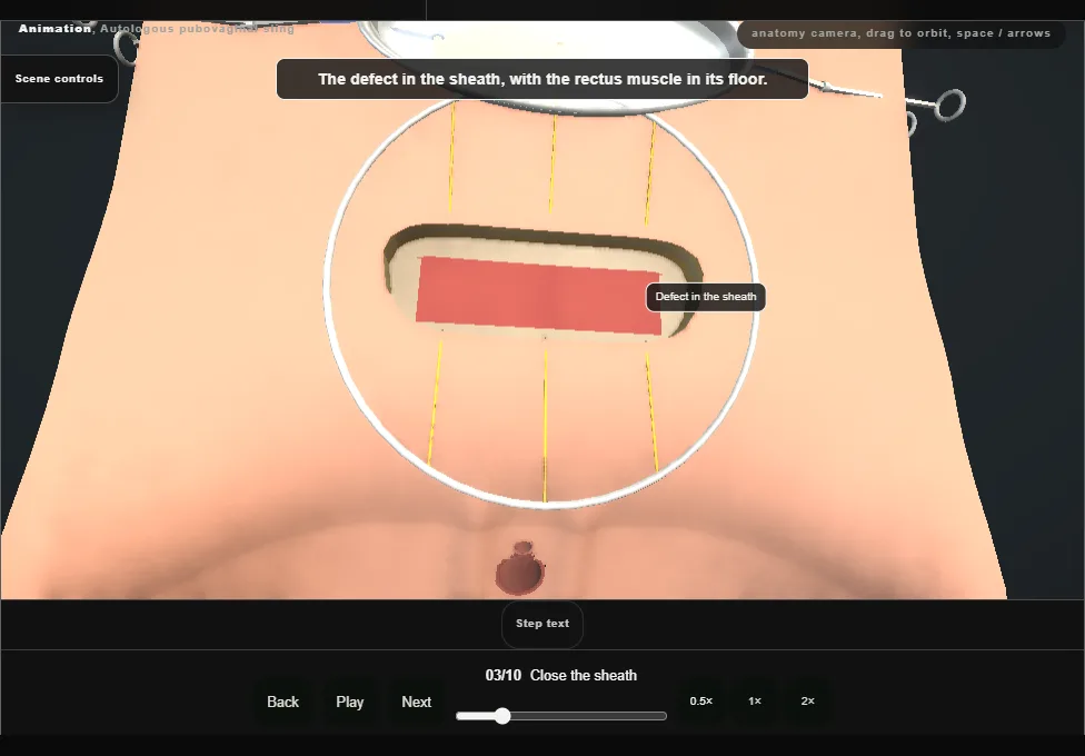 Autologous pubovaginal sling. Step 3: Close the sheath. Captured frame from the interactive animation.