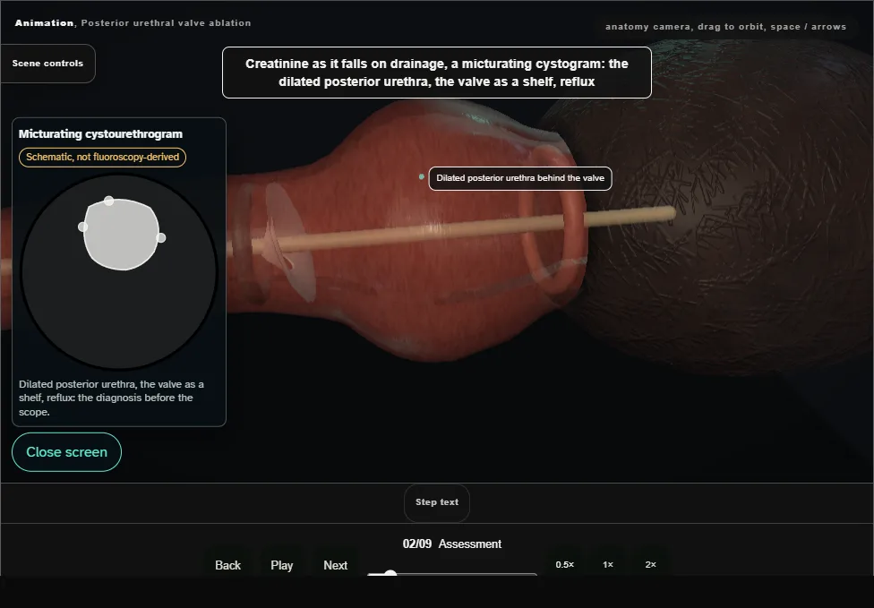 Posterior urethral valve ablation. Step 2: Assessment. Captured frame from the interactive animation.