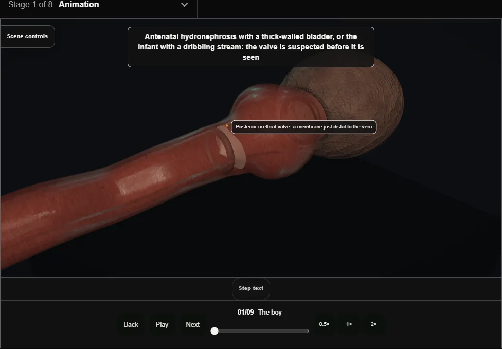 Posterior urethral valve ablation. Step 1: The boy. Captured frame from the interactive animation.