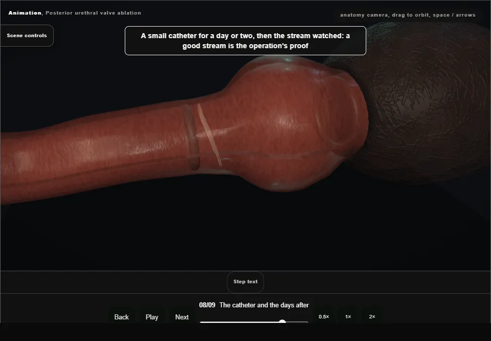 Posterior urethral valve ablation. Step 8: The catheter and the days after. Captured frame from the interactive animation.