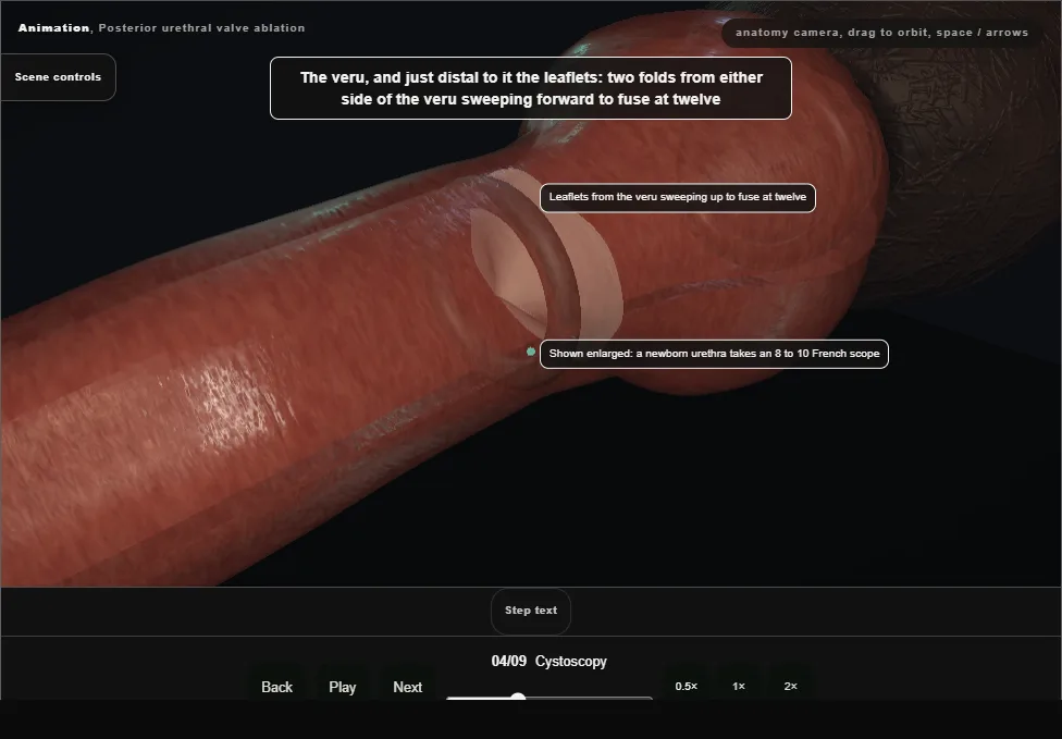 Posterior urethral valve ablation. Step 4: Cystoscopy. Captured frame from the interactive animation.
