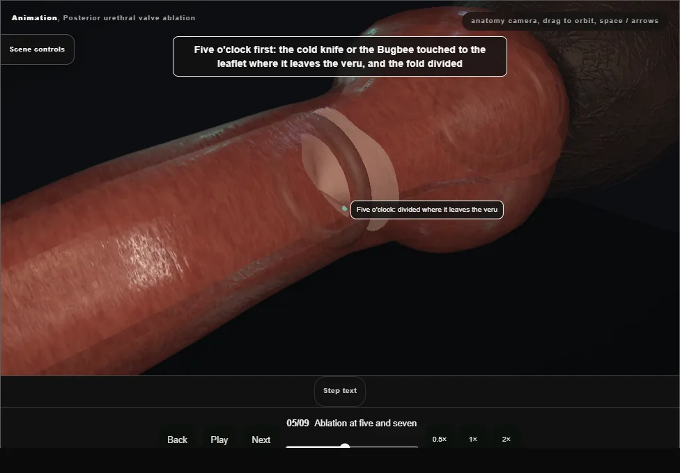 Posterior urethral valve ablation. Step 5: Ablation at five and seven. Captured frame from the interactive animation.