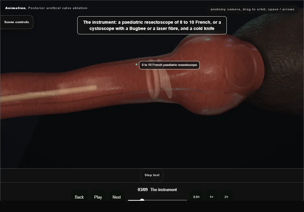 Posterior urethral valve ablation. Step 3: The instrument. Captured frame from the interactive animation.