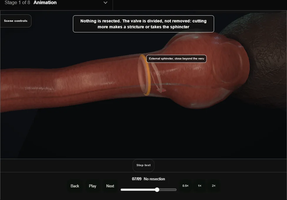 Posterior urethral valve ablation. Step 7: No resection. Captured frame from the interactive animation.