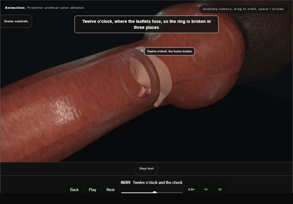 Posterior urethral valve ablation. Step 6: Twelve o'clock and the check. Captured frame from the interactive animation.