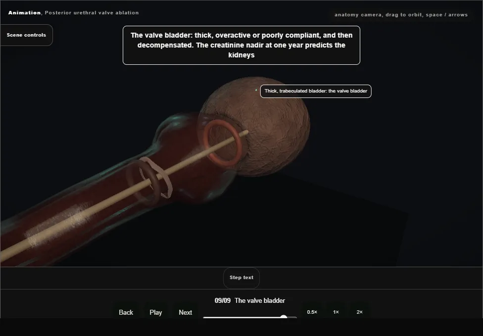 Posterior urethral valve ablation. Step 9: The valve bladder. Captured frame from the interactive animation.