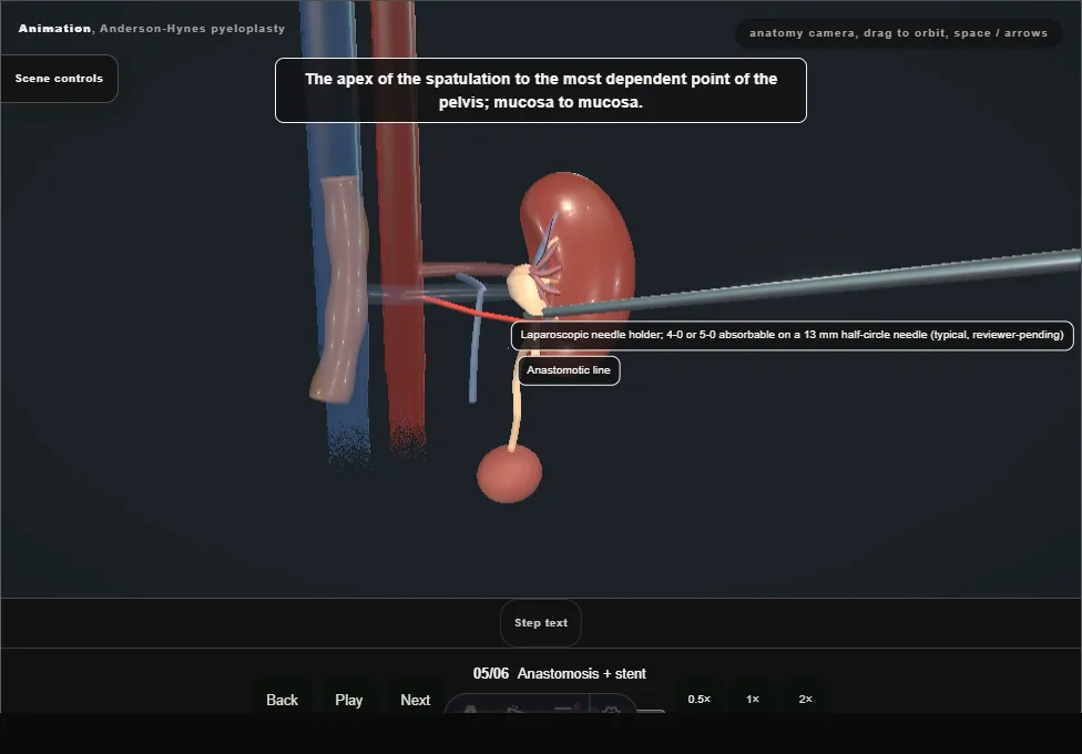 Anderson-Hynes pyeloplasty. Step 5: Anastomosis + stent. Captured frame from the interactive animation.