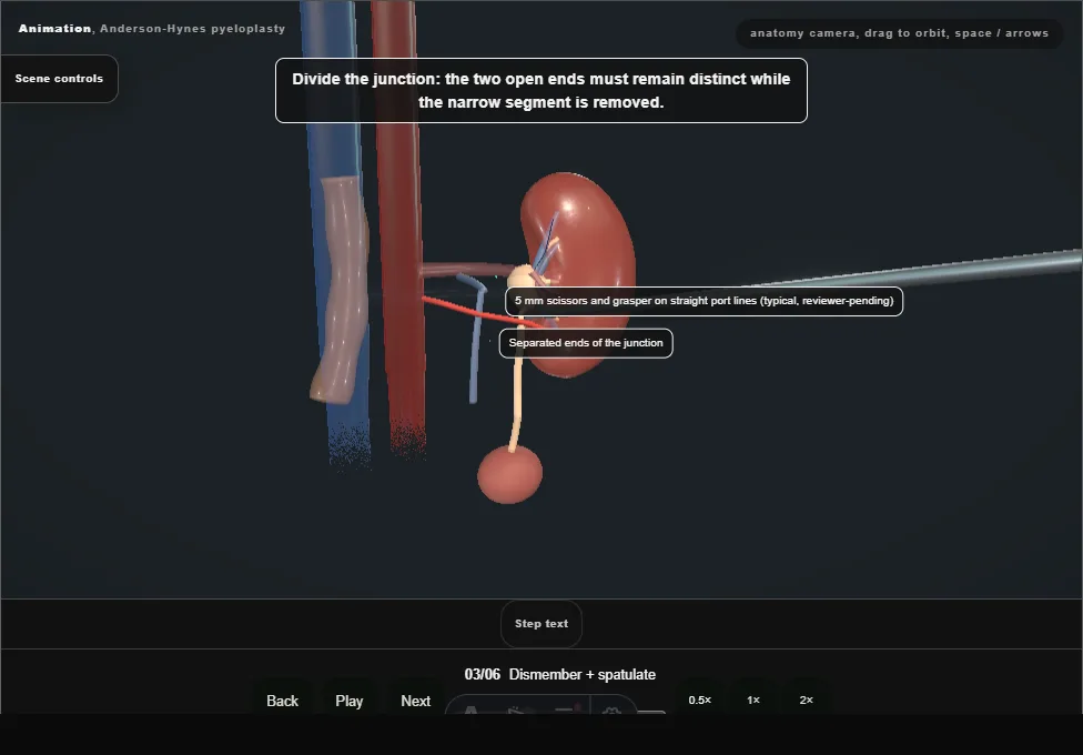 Anderson-Hynes pyeloplasty. Step 3: Dismember + spatulate. Captured frame from the interactive animation.