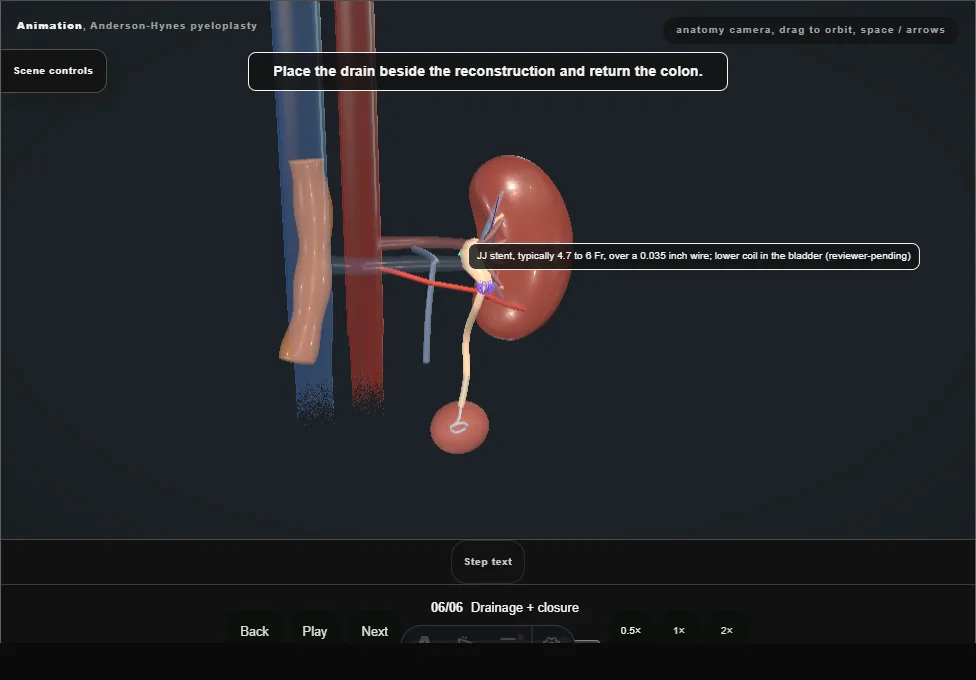 Anderson-Hynes pyeloplasty. Step 6: Drainage + closure. Captured frame from the interactive animation.
