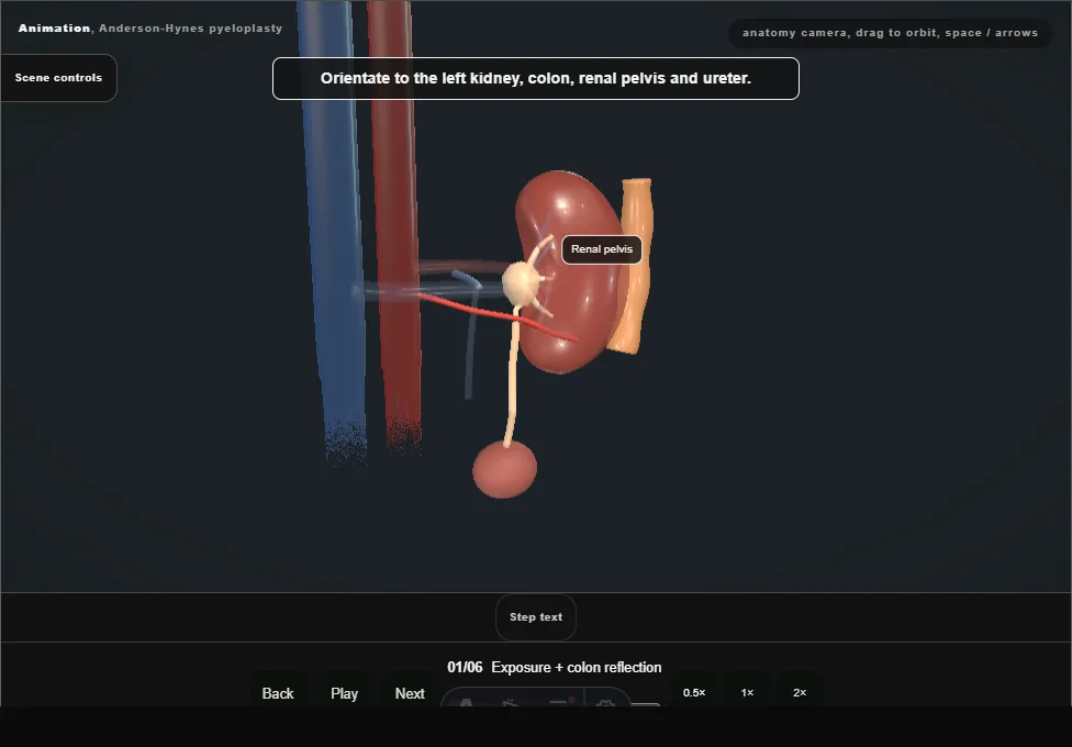 Anderson-Hynes pyeloplasty. Step 1: Exposure + colon reflection. Captured frame from the interactive animation.