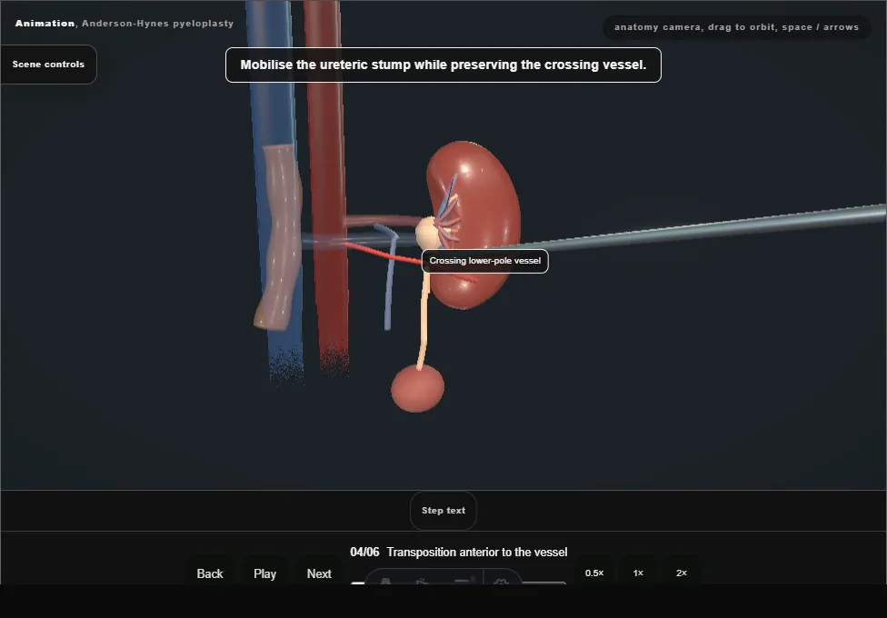 Anderson-Hynes pyeloplasty. Step 4: Transposition anterior to the vessel. Captured frame from the interactive animation.
