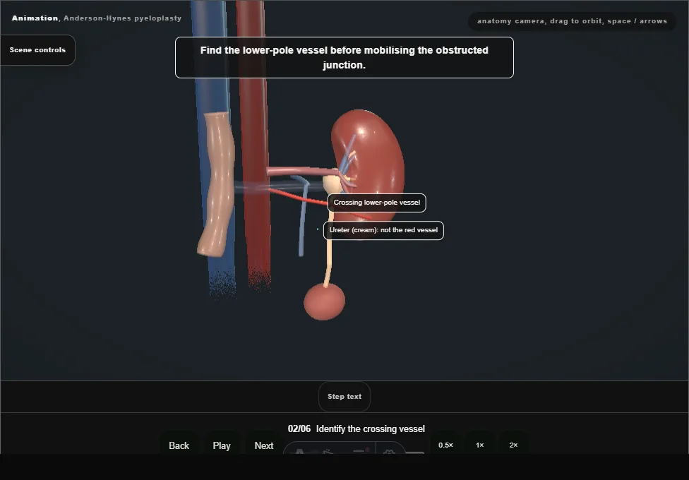 Anderson-Hynes pyeloplasty. Step 2: Identify the crossing vessel. Captured frame from the interactive animation.
