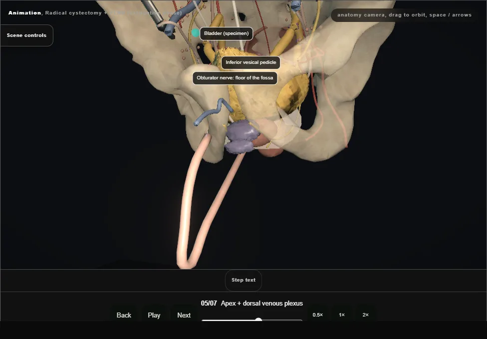 Radical cystectomy + PLND (extirpative phase). Step 5: Apex + dorsal venous plexus. Captured frame from the interactive animation.