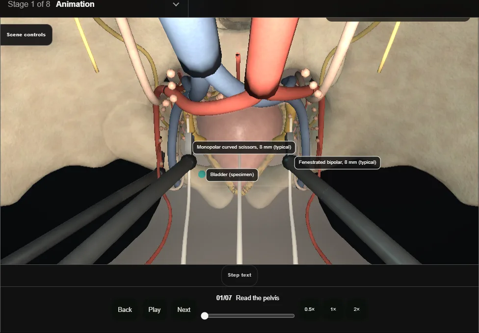 Radical cystectomy + PLND (extirpative phase). Step 1: Read the pelvis. Captured frame from the interactive animation.