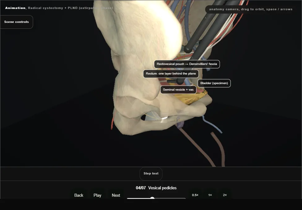 Radical cystectomy + PLND (extirpative phase). Step 4: Vesical pedicles. Captured frame from the interactive animation.