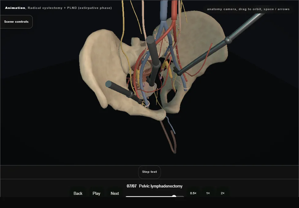 Radical cystectomy + PLND (extirpative phase). Step 7: Pelvic lymphadenectomy. Captured frame from the interactive animation.